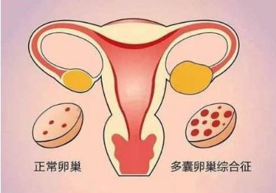 多囊卵巢综合征能治疗吗？还是只能通过做试管来获