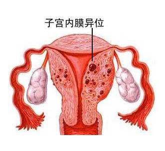 为什么会发生子宫内膜异位症？该怎么治疗？