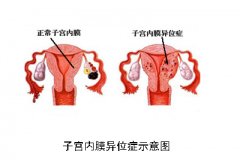 泰国试管婴儿治疗子宫内膜异位症
